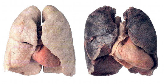 Poumon: sain contre fumeur