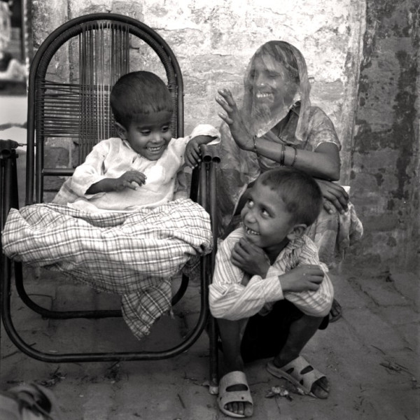 Cancer de la peau chez un enfant, Inde